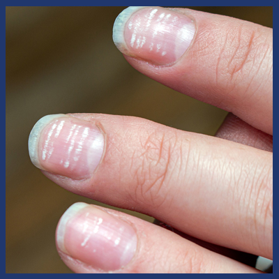 What Nails Reveal About Your Inner Nutrition Status