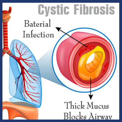 cystic fibrosis lungs diagram