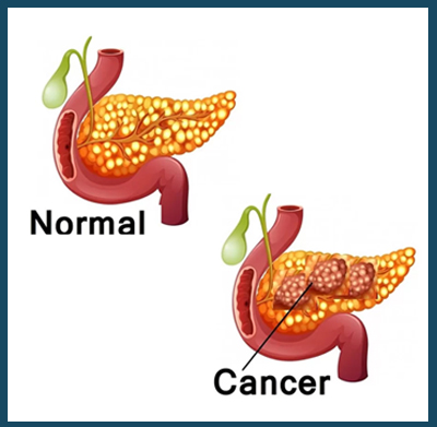 homeopathic treatment for Pancreatic cancer in homeopathy, Pancreatic ...