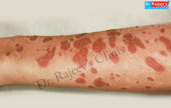 Stevens Johnson Syndrome Mild Rash