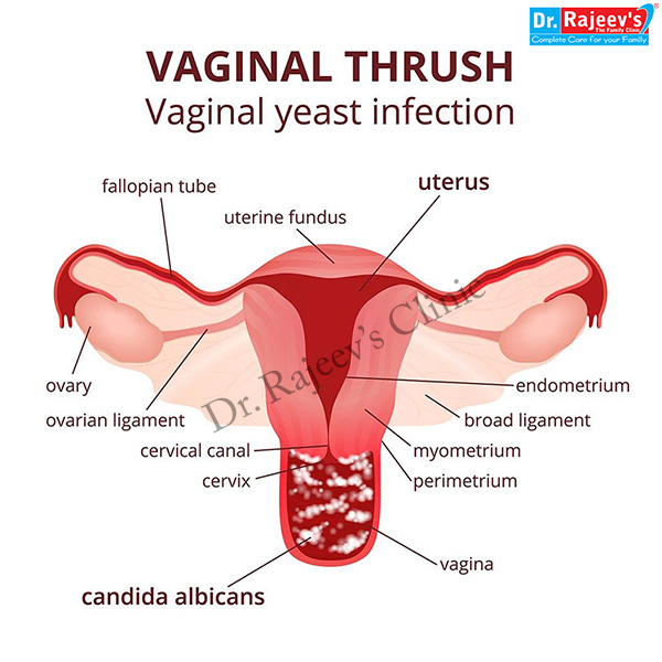 thrush symptoms women