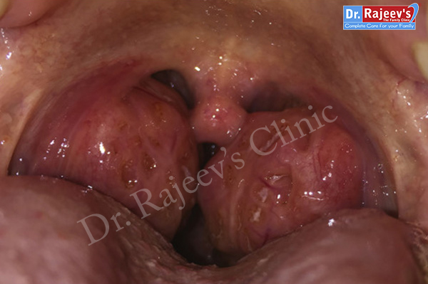 Homeopathy Treatment for ACUTE TONSILLITIS